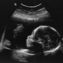 Afbeelding: een echografie van een foetus.